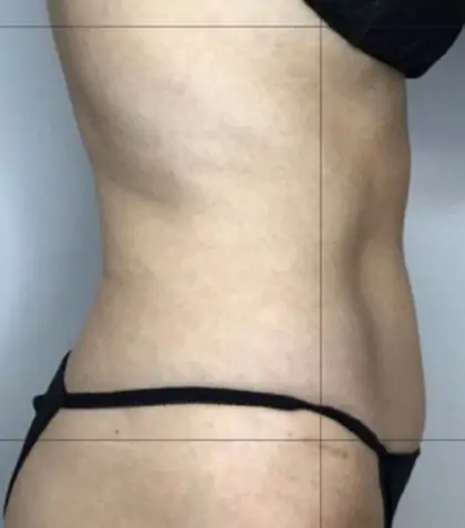 Before Image: Liposuction - right-side
