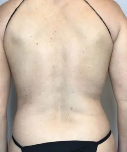 Before Image: Liposuction - back