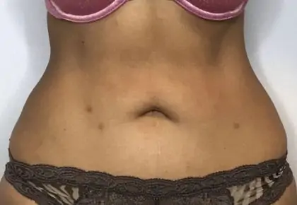 After Image: Liposuction - front