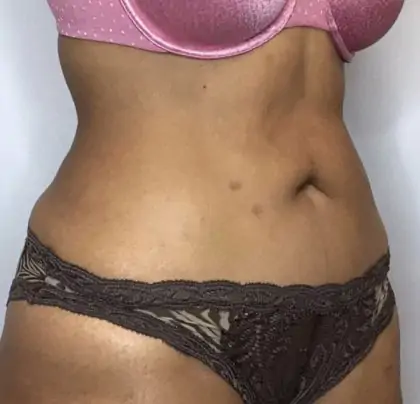 After Image: Liposuction - right-front-oblique
