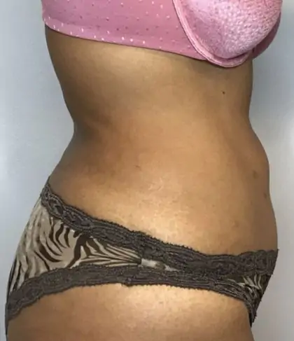 After Image: Liposuction - right-side