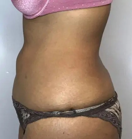 After Image: Liposuction - left-side