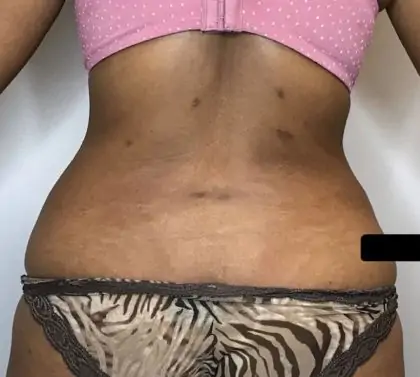 After Image: Liposuction - back