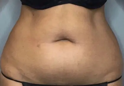Before Image: Liposuction - front