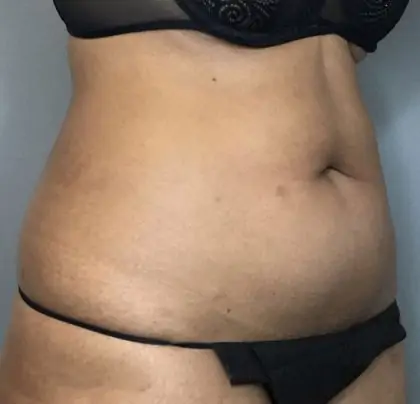 Before Image: Liposuction - right-front-oblique