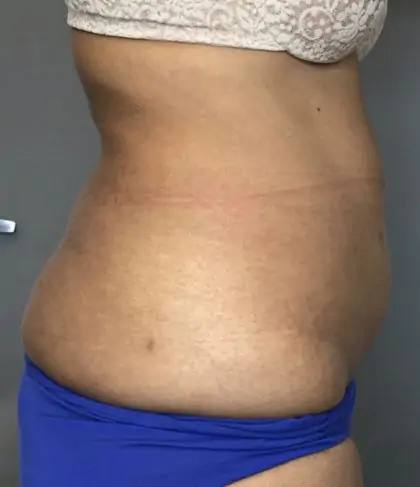 Before Image: Liposuction - right-side