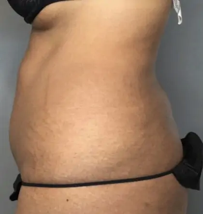 Before Image: Liposuction - left-side