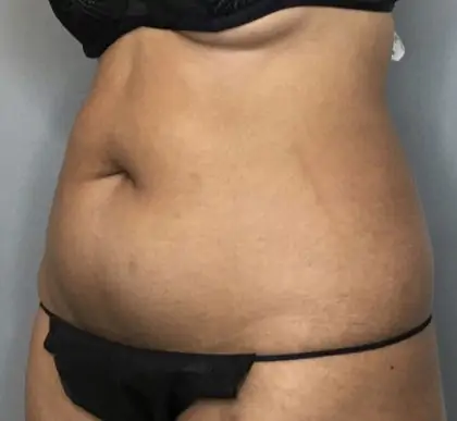 Before Image: Liposuction - left-front-oblique