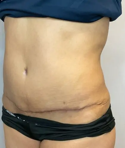After Image: Liposuction, Tummy Tuck - left-front-oblique