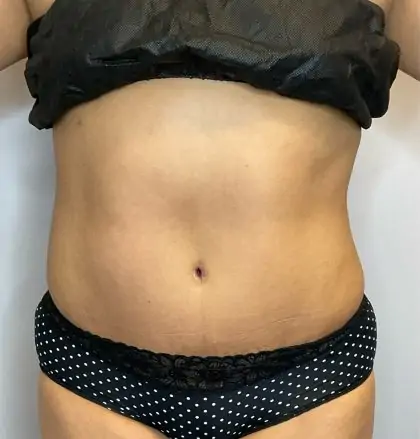 After Image: Liposuction, Tummy Tuck - front