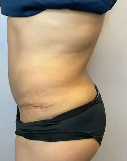 After Image: Liposuction, Tummy Tuck - left-side