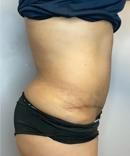After Image: Liposuction, Tummy Tuck - right-side