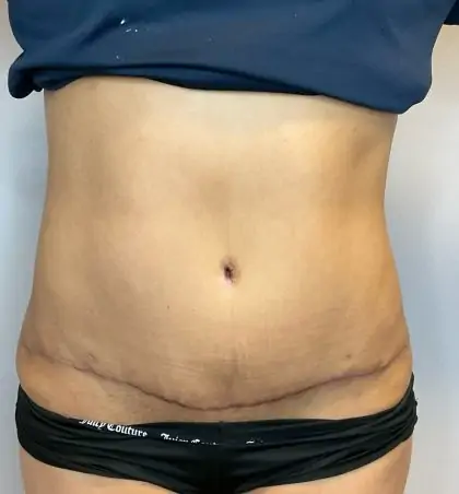 After Image: Liposuction, Tummy Tuck - front