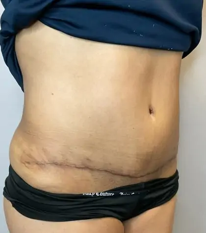 After Image: Liposuction, Tummy Tuck - right-front-oblique