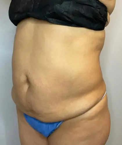 Before Image: Liposuction, Tummy Tuck - front