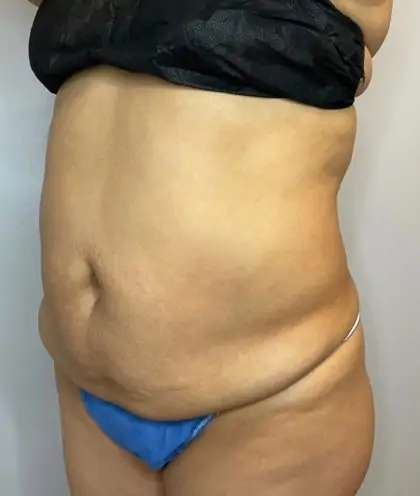 Before Image: Liposuction, Tummy Tuck - left-front-oblique
