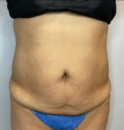 Before Image: Liposuction, Tummy Tuck - front