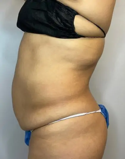 Before Image: Liposuction, Tummy Tuck - left-side