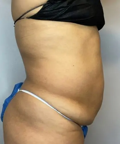 Before Image: Liposuction, Tummy Tuck - right-side