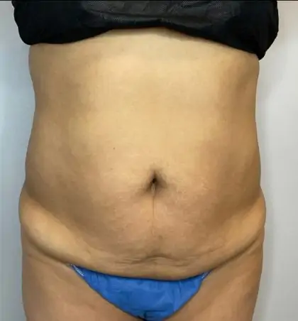 Before Image: Liposuction, Tummy Tuck - front