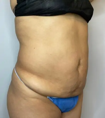 Before Image: Liposuction, Tummy Tuck - right-front-oblique