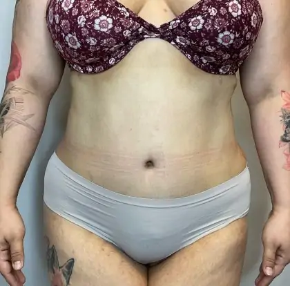 After Image: Liposuction, Tummy Tuck - front