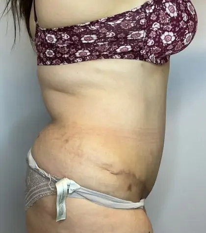 After Image: Liposuction, Tummy Tuck - right-side