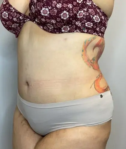 After Image: Liposuction, Tummy Tuck - left-front-oblique