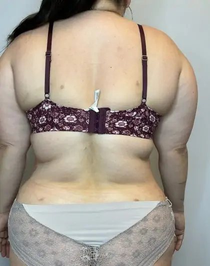 After Image: Liposuction, Tummy Tuck - back