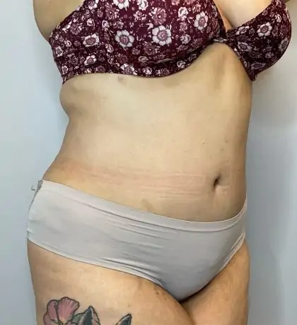 After Image: Liposuction, Tummy Tuck - right-front-oblique