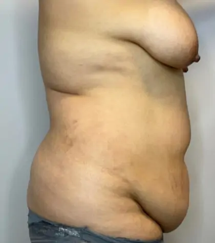 Before Image: Liposuction, Tummy Tuck - right-side