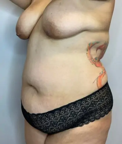 Before Image: Liposuction, Tummy Tuck - left-front-oblique