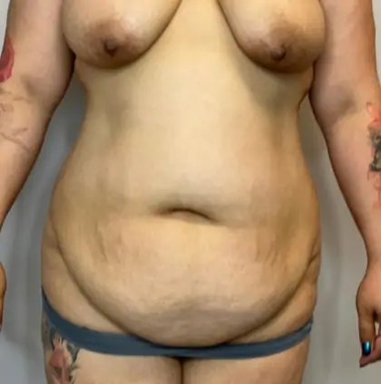 Before Image: Liposuction, Tummy Tuck - front