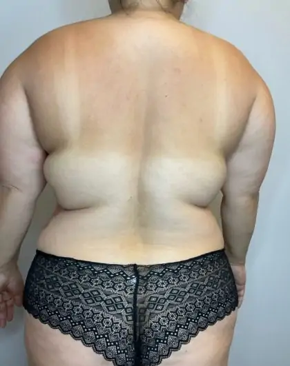 Before Image: Liposuction, Tummy Tuck - back