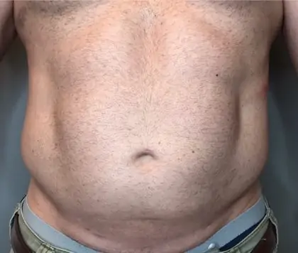 After Image: Liposuction - front
