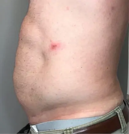 After Image: Liposuction - left-side