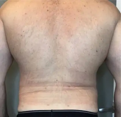 After Image: Liposuction - back