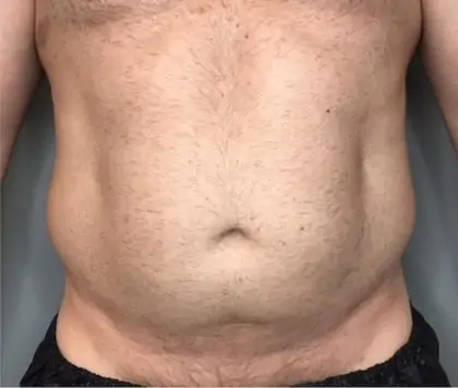 Before Image: Liposuction - front