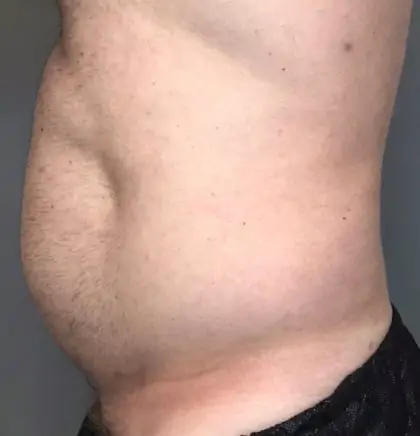 Before Image: Liposuction - left-side
