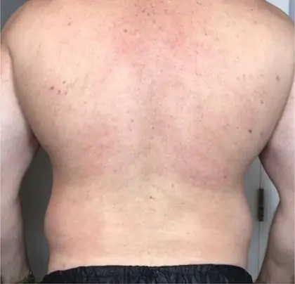 Before Image: Liposuction - back