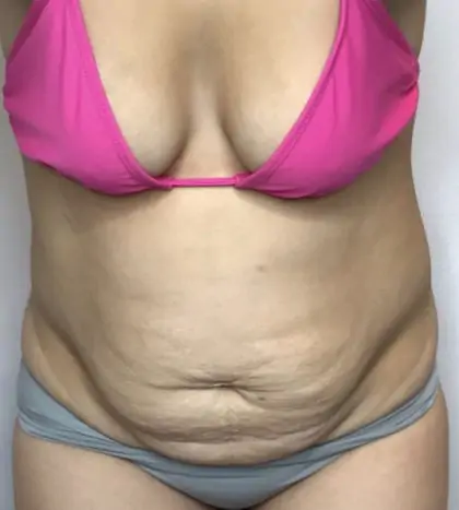 Before Image: Mommy Makeover - front