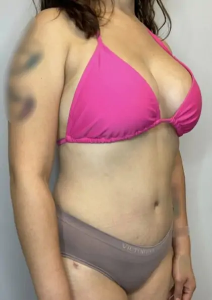 After Image: Mommy Makeover - right-front-oblique