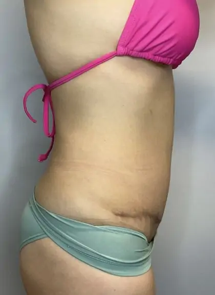 After Image: Mommy Makeover - right-side