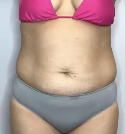 Before Image: Mommy Makeover - front