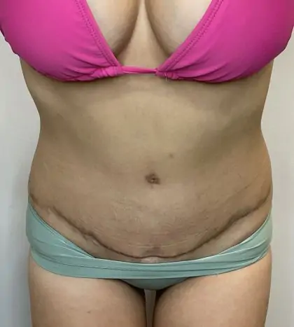 After Image: Mommy Makeover - front