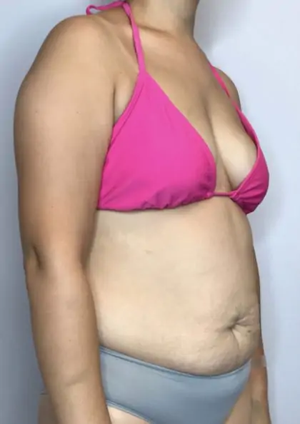 Before Image: Mommy Makeover - right-front-oblique
