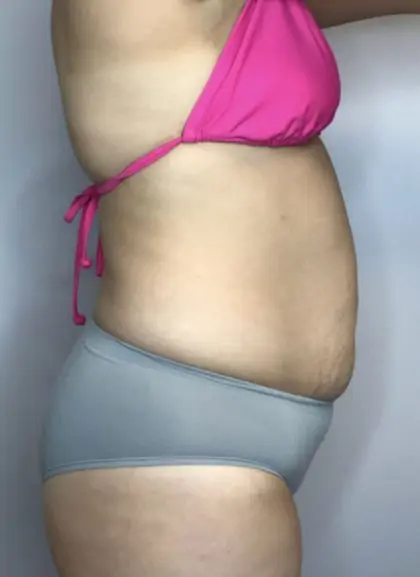 Before Image: Mommy Makeover - right-side