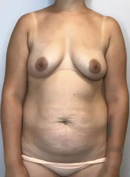 Before Image: Mommy Makeover - front