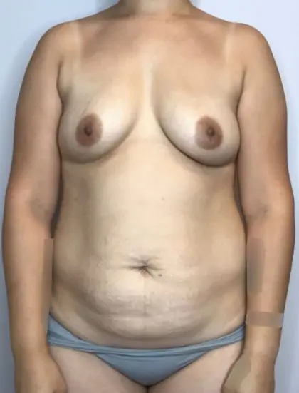 Before Image: Mommy Makeover - front