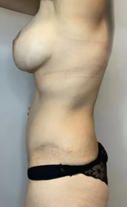 After Image: Mommy Makeover - left-side